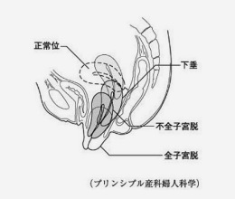 子宮下垂・子宮脱